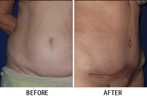 Abdominoplasty