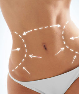 Abdominoplasty 