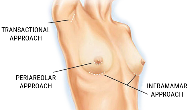 Breast Augmentation