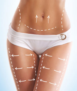 liposuction