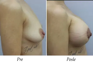 Breast Augmentation - Patient 03
