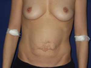 Abdominoplastika - Pacijent 1
