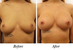 Breast augmentation - patient 15 Breast augmentation - patient 15