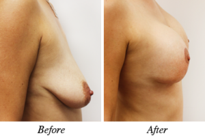 Breast lift - patient 14 Breast lift - patient 14