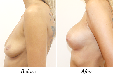 Breast lift&augmentation - Patient 20 Breast lift&augmentation - Patient 20