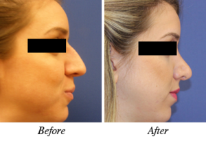 Nose correction - patient 3