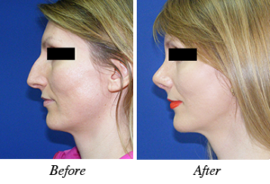 Nose correction - before after patient 11 Nose correction - patinet 11