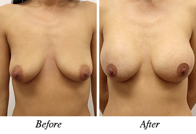 Patient 14 - before and after breast augmentation