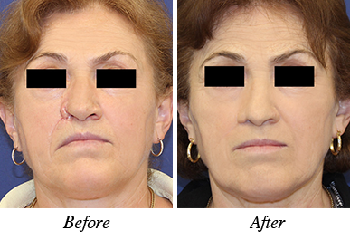 Patient 20 - Before and after nose correction