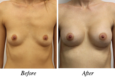 Patient 23 - before and after breast augmentation