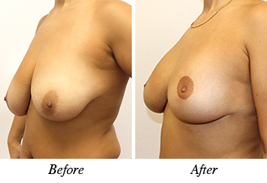 Patient 25 - before and after breast lift and augmentation