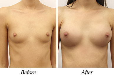 Patient 26 - Before and after breast augmentation