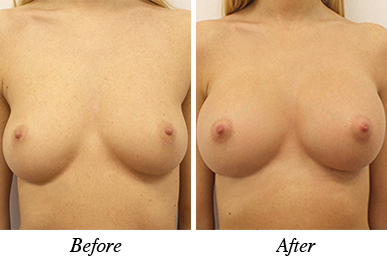 Patient 27 - Before and after breast augmentation