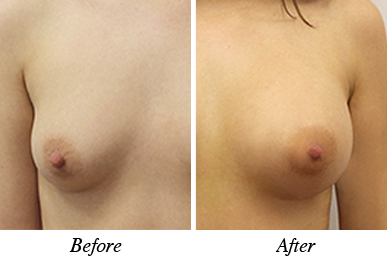 Patient 28 - Before and after breast augmentation