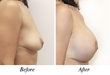 Patient 29 - Before and after breast augmentation