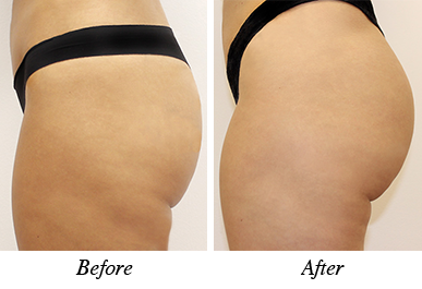 Patient 3 - before and after buttock augmentation