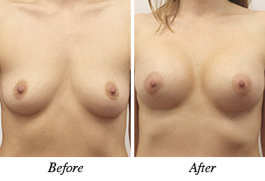 Patient 30 - Before and after breast augmentation