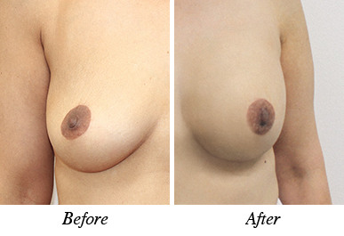 Patient 31 - Before and after breast augmentation