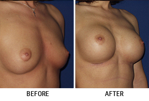 Breast Augmentation - Patient 01