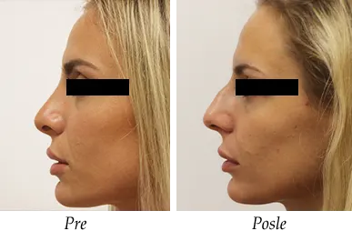 Nose correction- patient 1