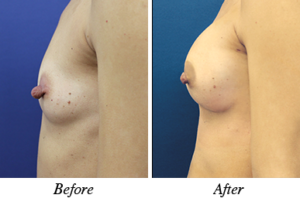 nipple correction and breast augmentation - patient 12 nipple correction and breast augmentation - patient 12