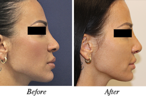 nose correction before after