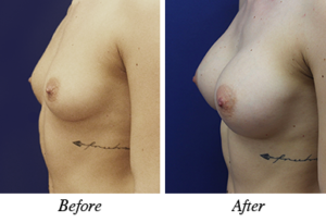 Breast Augmentation - Patient 13 breast augmentation - patient 13