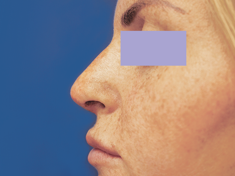 Nose correction - Patient 4