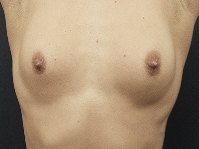 Patient 13 --- Before breast augmentation