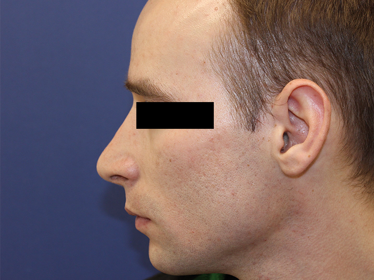 Nose correction – Patient 6