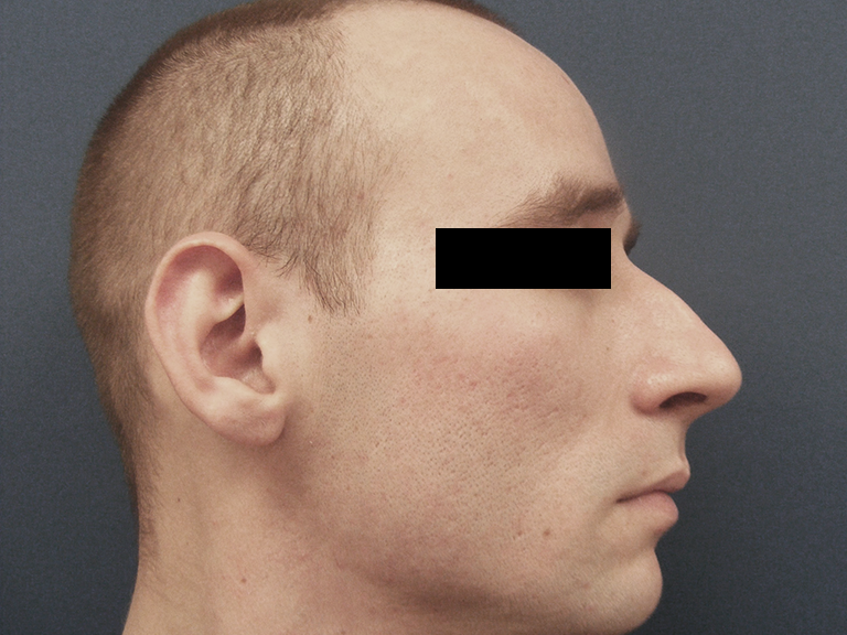 Nose correction – Patient 6