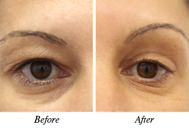 Patient 6 - Before and after blepharoplasty