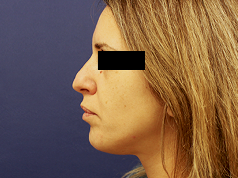 Korekcija nosa pre--pacijent 7