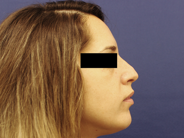 Korekcija nosa pre - pacijent 7