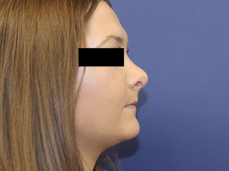 Nose correction - patient 8