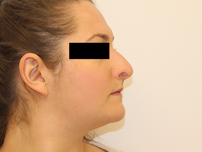 Nos pre i posle pacijent 8