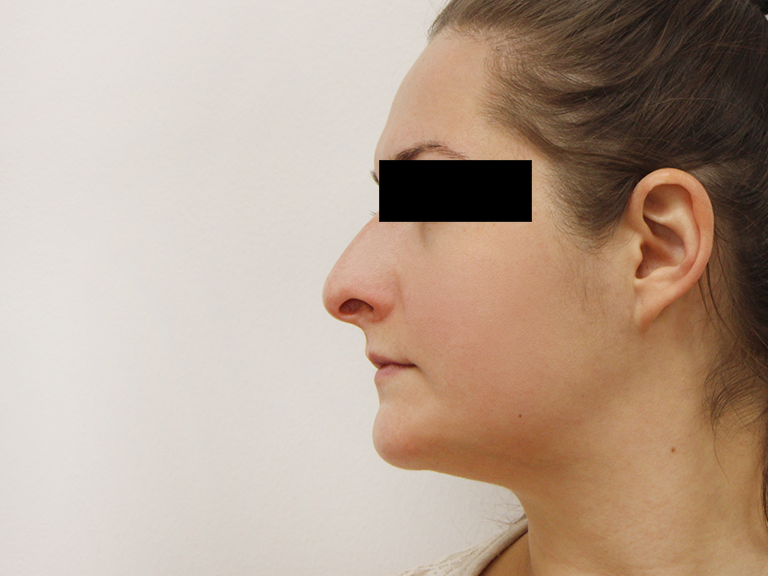 Nose correction - patient 8