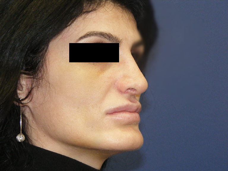 Korekcija nosa posle - pacijent 9