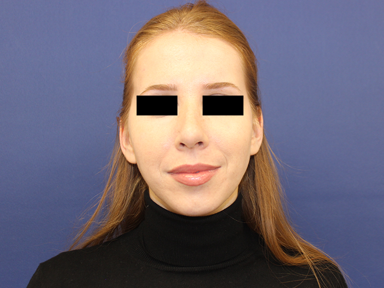 Nose correction after -patient10