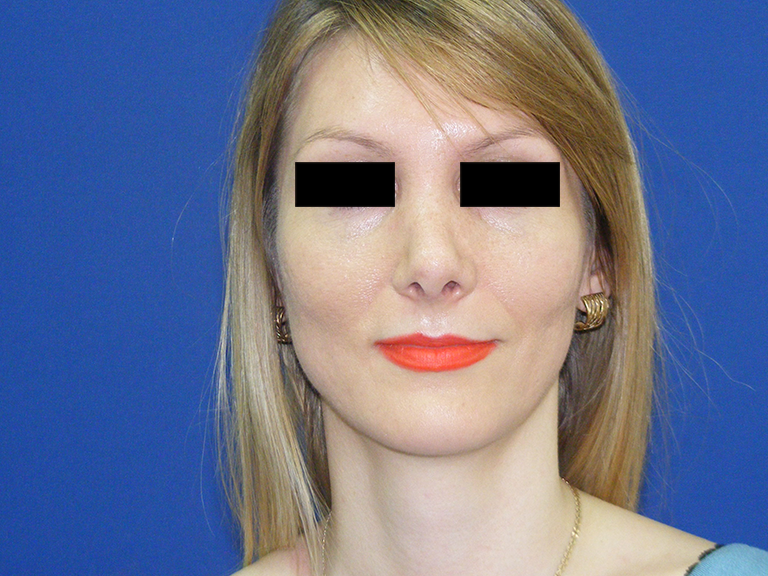 Korekcija nosa posle --pacijent 11