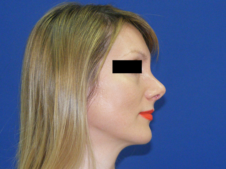 Korekcija nosa posle - pacijent 11