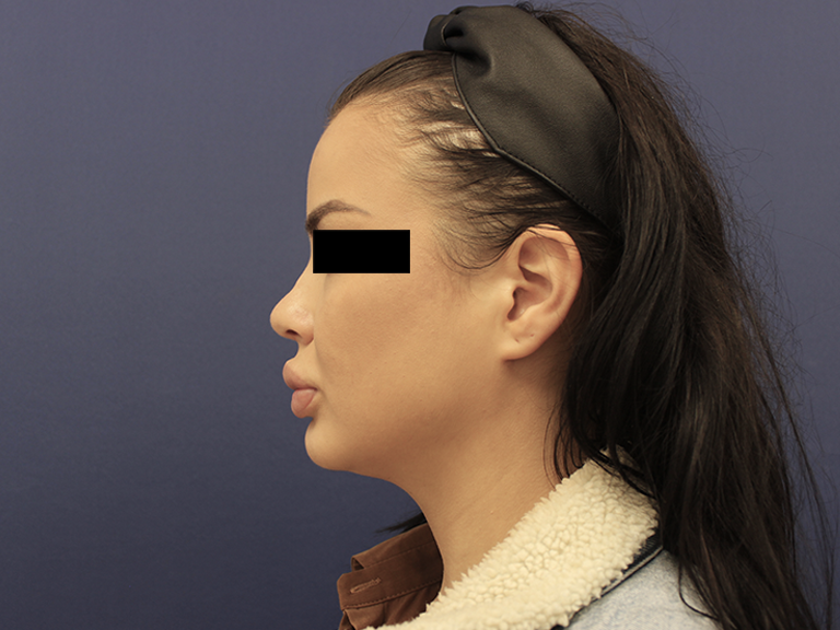 Korekcija nosa posle - pacijent 12