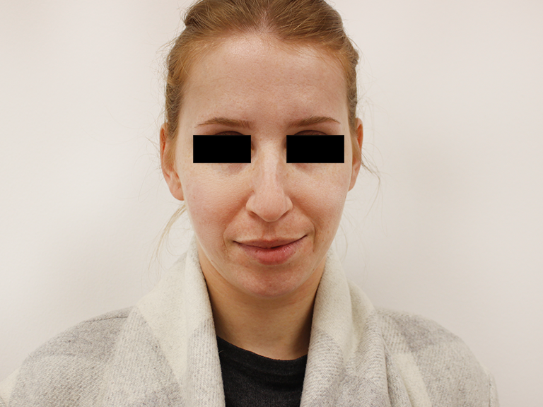 Nose correction before -patient10