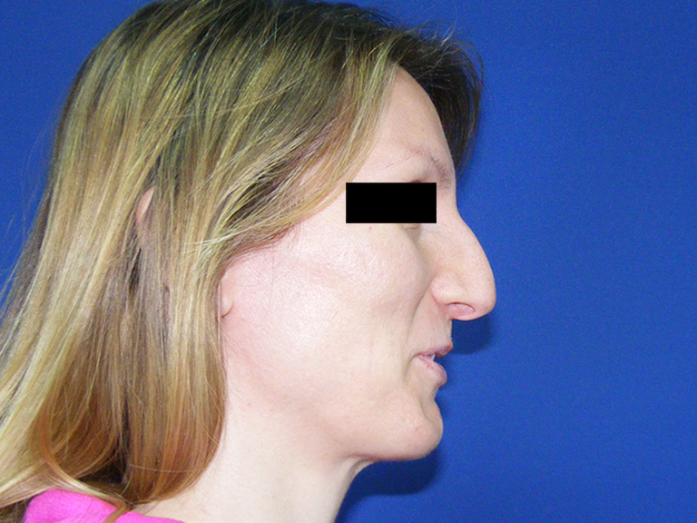 Korekcija nosa pre -pacijent 11