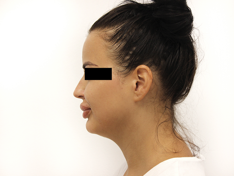 Korekcija nosa pre -pacijent 12