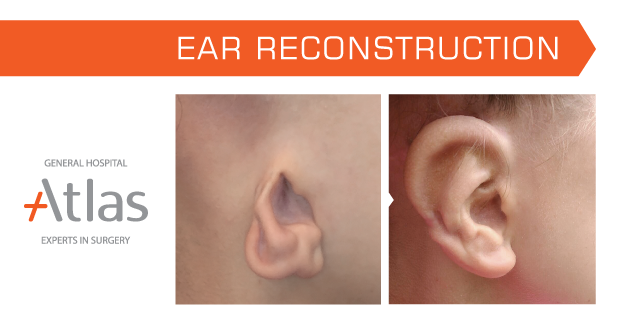 Ear reshaping