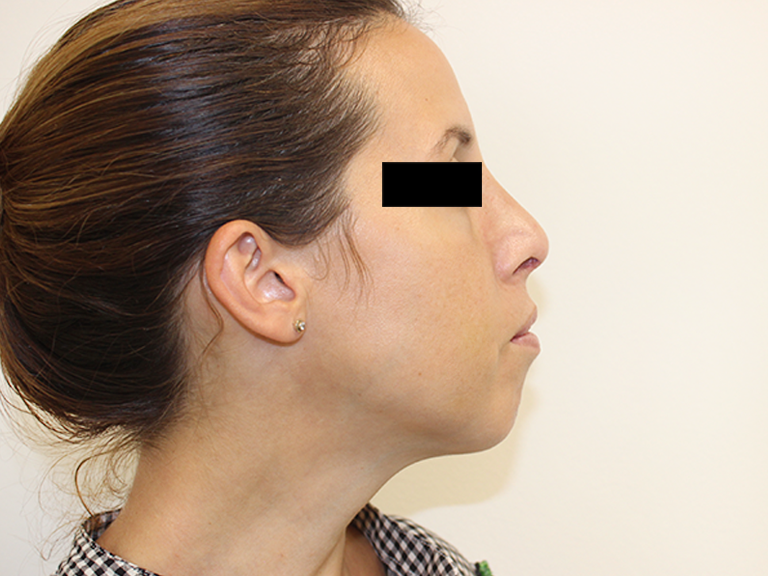 Nose correction - patient 14