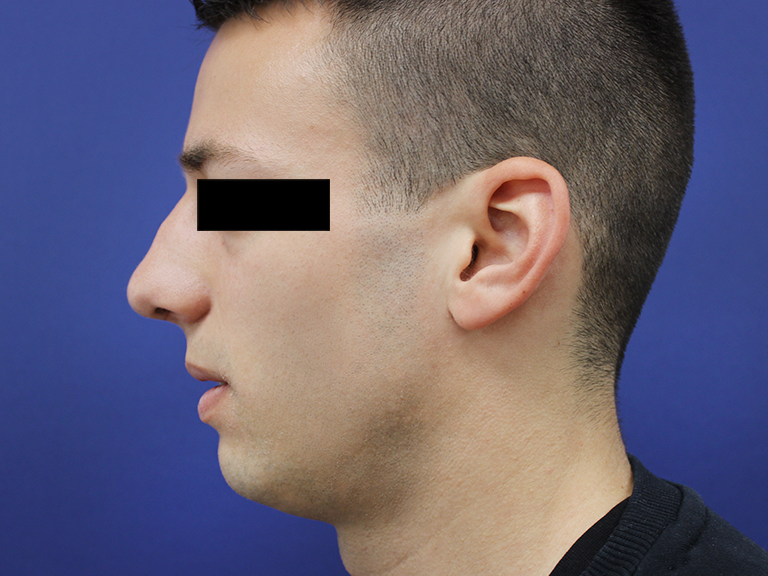 Nose correction - patient 15