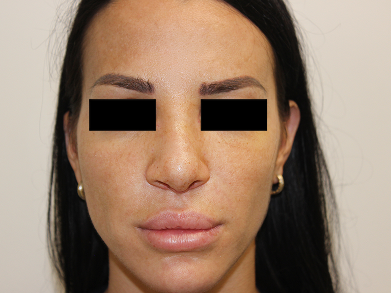 Nose correction - patient 16