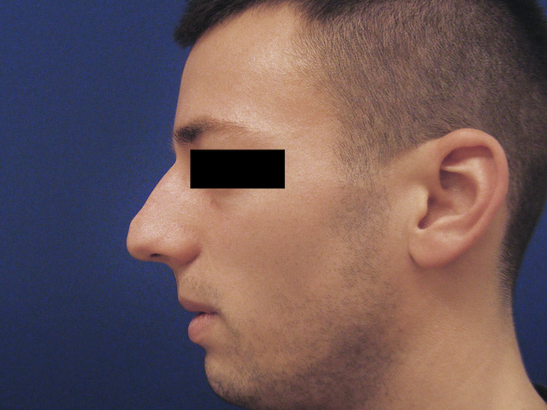 Nose correction - patient 15